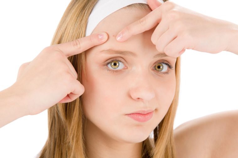 How Forehead Acne Causes Occurred And How To Solve