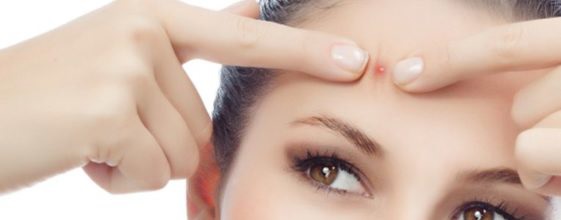 How Forehead Acne Causes Occurred And How To Solve