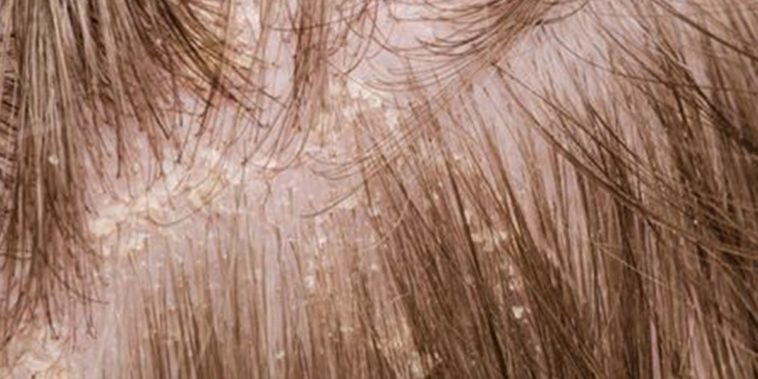 Ways To Get Rid Of Dandruff Naturally 1