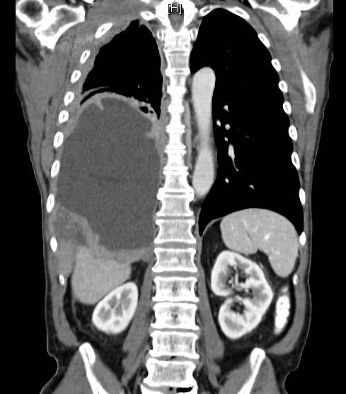What Is Pleural Mesothelioma