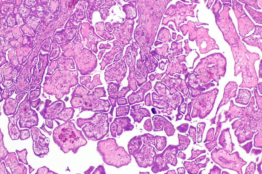 What Is Pleural Mesothelioma